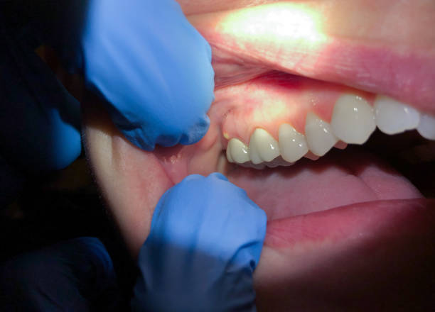 Best Emergency Dentist for Lost Fillings or Crowns in Social Circle, GA