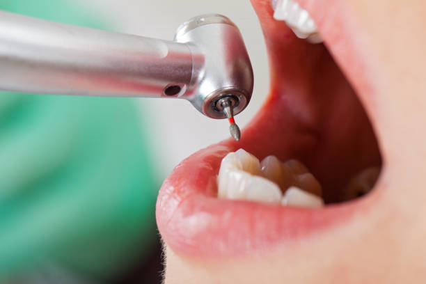 Best Emergency Dentist for Knocked-Out Tooth in Social Circle, GA